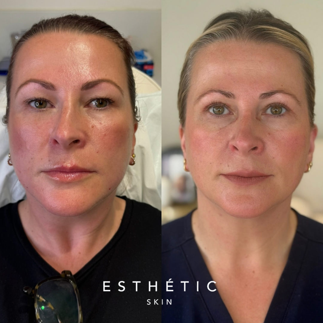 Blepharoplasty