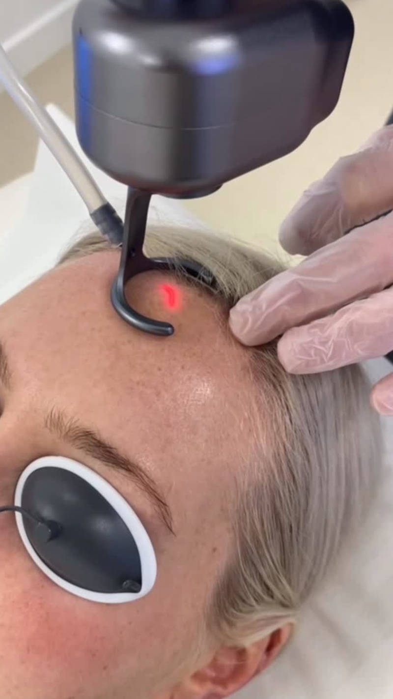 Fractional CO₂ Laser Treatment